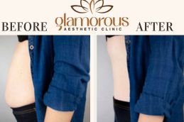 Before and After Liposuction In Riyadh Saudia