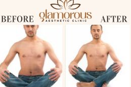 _Before and After Result Gynecomastia male (1)