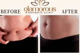 Before and After Results of Mounjaro Injections Saudia