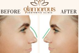 Before and After Rhinoplasty result In Riyadh KSA