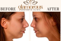 Before and After Rhinoplasty result In Riyadh