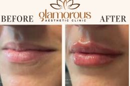 Before and After of Lip Fillers Injections saudia Arabia