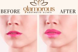 Before and After of Lip Fillers Riyadh , KSA