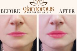 Before and After of Lip Fillers Riyadh , saudi Arab