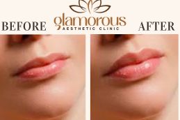 Before and After of Lip Fillers saudia Arabia (1)