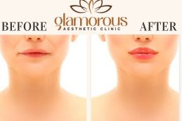 Before and After of Lip Fillers saudia Arabia KSA