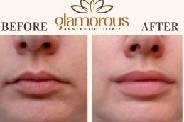 Before and After of Lip Fillers saudia Arabia