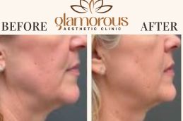 Before and After of prp Injections Riyadh (1)