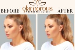 Before and After of prp Injections Riyadh