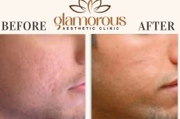 Before and After of prp Injections saudia (1)