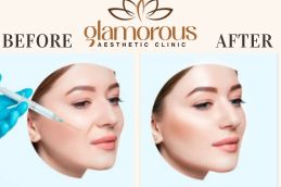 Before and After of prp Injections saudia Arabia (1)