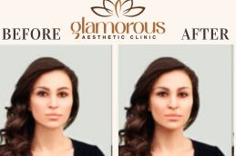 Before and After of prp Injections saudia Arabia