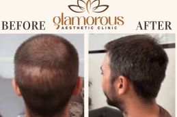 Before and After of prp Injections saudia