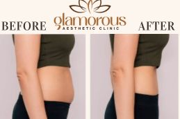 Before and After of weight loss Riyadh , KSA