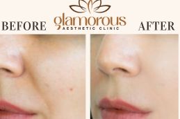 Before and After result IV Drip Riyadh Saudia
