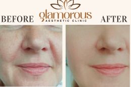 Before and After result IV Drip Riyadh