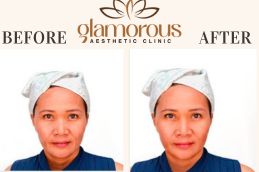 Before and After result IV Drip
