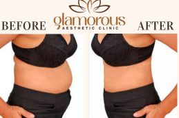 Before and After result Liposuction In Riyadh KSA