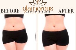 Before and After result weight loss saudi Arab 