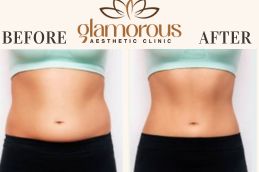 Before and After result weight loss saudi Arab