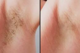 Before and after riyad saudia