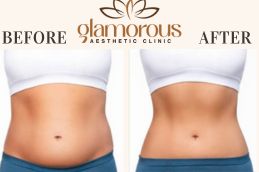 Before and After weight loss in Riyadh , KSA (1)