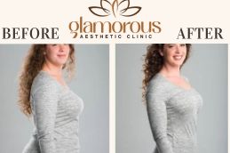 Before and After weight loss in Riyadh , KSA