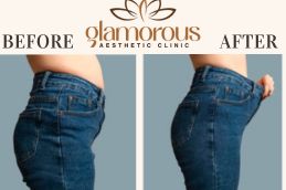 hest Before and After result Liposuction In Riyadh