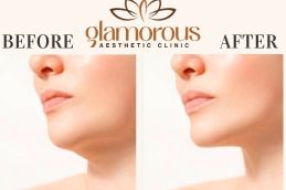 Face Before and After result Liposuction In Riyadh