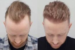 Hair Transplant before and after in saudia