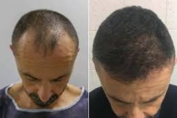 Hair transplant before and after result 