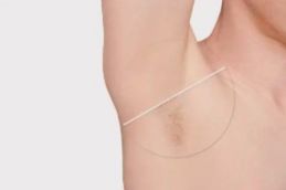 Laser hair removal before and afetr