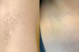 laser hair removal in riyad saudia