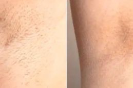 laser hair removal before and after saudia