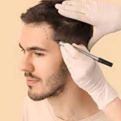 hair transplant in Reyadh