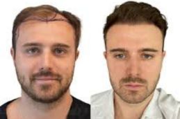 result of hair transplant reyad saudia