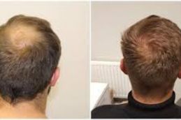 Result of hair transplant KSA