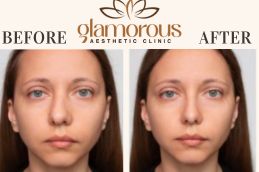 Rhinoplasty Before and After result In Riyadh KSA SAUDIA