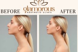 Rhinoplasty Before and After result In Riyadh KSA