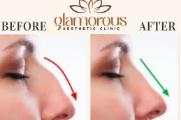 Rhinoplasty Before and After result In Riyadh