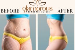 Tummy Tuck Before and After KSA
