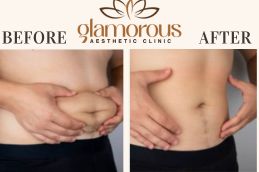 Tummy Tuck Before and After KSA (1)