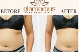 Tummy Tuck Before and After Result Saudia