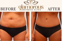 Tummy Tuck Before and After Result Saudia (1)