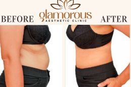 Tummy Tuck Before and After Result Saudia Arabia