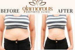 Tummy Tuck Before and After Result Saudia KSA