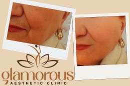 before and After Gluta injections in Riyadh Saudia