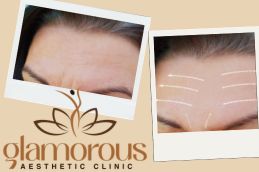 before and After Glutathione injections in Riyadh Saudia (KSA)