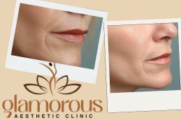 before and After Result Cosmetic Injectables in Riyadh