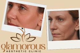 before and After Result Cosmetic Injectables in Riyadh Saudia 